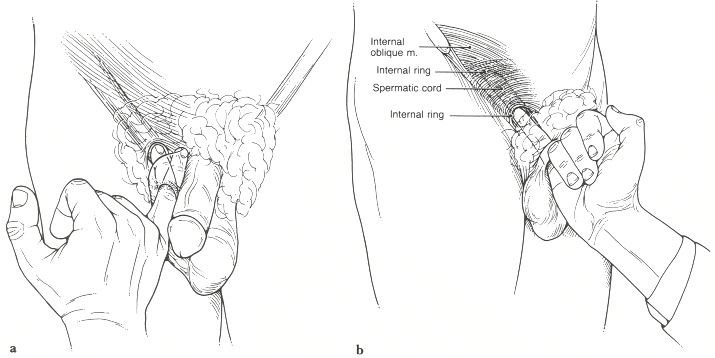 Figure 80.14. Palpation of the inguinal region, (a) The examiner inverts scrotal skin to palpate the inguinal canal.