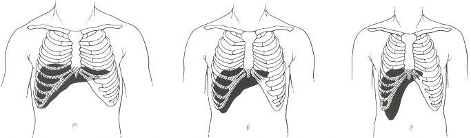 Figure 94.1. Frontal views of the liver for different body types.