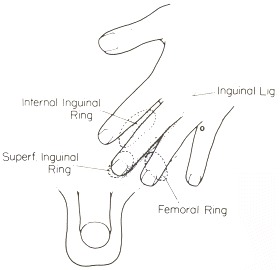 Figure 96.1. Placement of the hand when examining for a hernia.