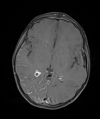 Right occipital and temporal leptomeningeal enhancement with enlarged choroid plexus in a patient with Sturge-Weber syndrome