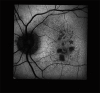 Video 1. . An animation of the progression of age-related macular degeneration (AMD), also called Geographic Atrophy (GA), over 6 years.