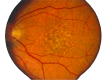 Figure 2. . Funduscopic image of classic drusen seen in AMD in human eye.
