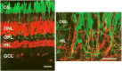 Figure 16. . Immunolabeling of rod photoreceptors with anti-opsin (green) in normal human and in retinitis pigmentosa retinas.