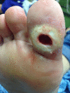 Diabetic Foot Ulcer Neuropathic ulceration in a patient with diabetes Note periwound callous formation