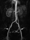 Fig. 20.10. A 37-year-old female patient with bilateral intermittent claudication.