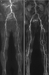 Fig. 20.2. Maximum intensity projection (MIP) images of non-contrast MRA (a) and corresponding contrast-enhanced MRA (b) in a 66-year-old male with intermittent claudication.