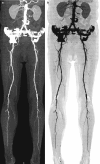 Fig. 20.4. Coronal MIP images with positive (a) and negative (b) contrast from a patient with significant infra-popliteal peripheral vascular disease.