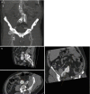 Fig. 20.7. Partial volume maximum intensity projection of bilateral common iliac artery aneurysms in a 68-year-old male (a).