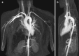 Fig. 20.8. Coronal (a) and sagittal (b) maximum intensity projections of thoracic MR angiogram show typical smooth elongated “hour-glass” narrowing of the descending thoracic aorta in a 22-year-old female patient with Takayasu disease.