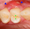 Vertical fracture of upper first premolar (green arrows) has caused a periodontal abscess (blue arrows)