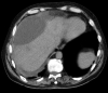 CT image showing hepatic biloma