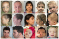 Figure 1. . Photographs of individuals with HYAL2 deficiency.