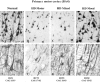 Figure 3.. Photomicrographs illustrating the pyramidal neurons in layer III in Brodmann area 4 of the primary motor cortex of normal (A,E) and Huntington's disease (B-D, F-H) cases with "mainly motor" (B,F), "mixed" (motor/mood) (C,G) and "mainly mood" (D,H) symptom profiles.