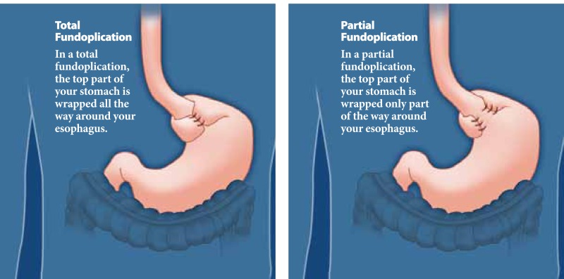 There are two types of surgery: total fundoplication and partial fundoplication.