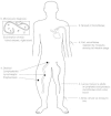 Figure 92-1. Life cycle of Wuchereria and Brugia.