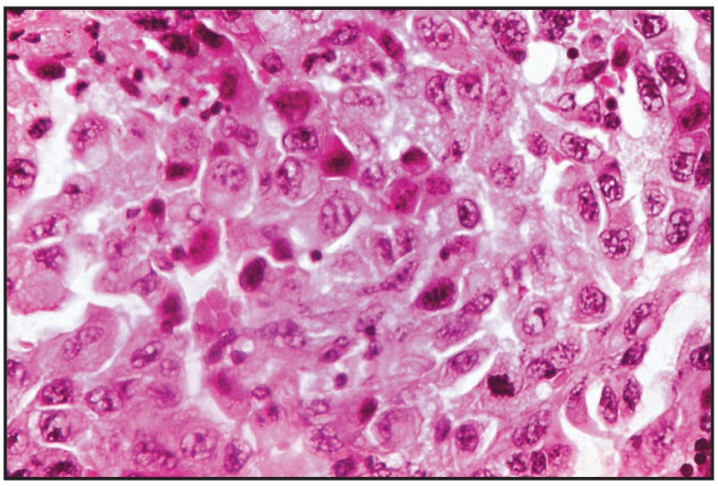 Infiltrating transitional cell carcinoma, grade III, urinary bladder.