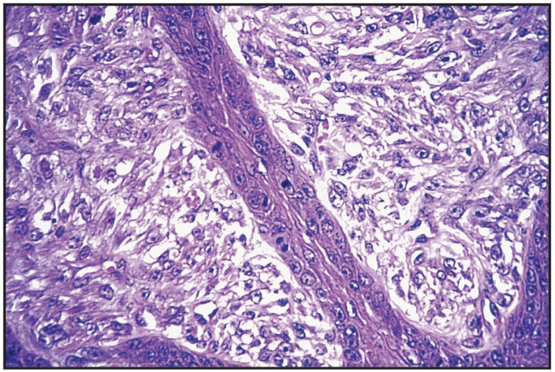 retention cysts or sebaceous cysts. +epidermal+inclusion+cyst