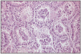 Fig. 7.16. Bronchioloalveolar adenocarcinoma.