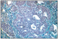 Fig. 7.18. Ovine pulmonary carcinoma.