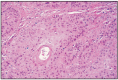 Fig. 7.2. Nasal squamos carcinoma, slight keratinization.