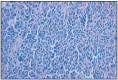 Fig. 7.4. Nasal spindle- cell carcinoma.