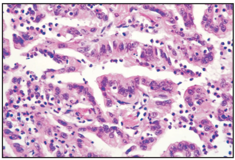 Fig. 7.9. Bronchial carcinoma.