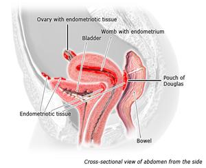 Illustration of endometriotic tissue