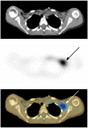 FIGURE 7.4. Neuroblastoma imaged with 131-I-meta-iodobenzylguanidine (MIBG) on a combined SPECT/CT instrument illustrates the benefit of correlating the functional data with the anatomical data.