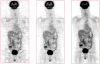 FIGURE 7.8. Images of clinical patient illustrate improvements due to image reconstruction: (left) filtered backprojection algorithm, (middle) iterative OSEM algorithm, (right) OSEM with detector response modeling.