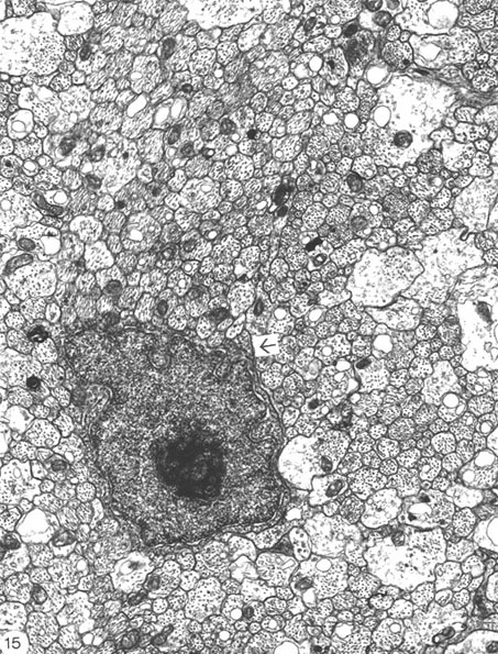 Figure 15. EM of 3-week-old lesion.