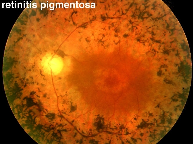 Figure 12b, [Fundus photo of a patient with retinitis pigmentosa.]. - Webvision - NCBI Bookshelf