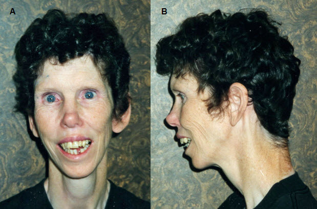 beckwith wiedemann syndrome adult