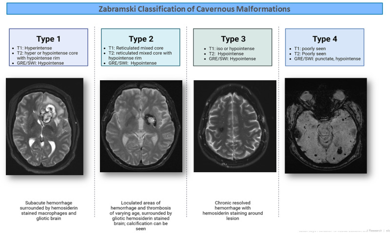 Figure 1. [Zabramski classification of cavernous malformations ...