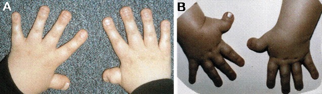 Figure 2. [Broad terminal phalanges (A) and broad, radially deviated thumbs  (B)]. - GeneReviews® - NCBI Bookshelf