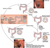 FIGURE WO-36. Fecal microbiota transplantation for patients with recalcitrant Clostridium difficile infection (CDI).