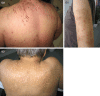 FIGURE 5.1. Typical skin changes due to uremic pruritus.