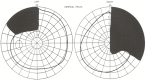 図116.9。 両頭半盲。