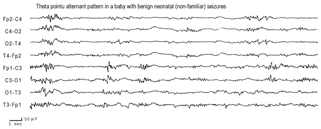 Figure 5.3. Inter-ictal EEG in a neonate with benign neonatal (non-familial) seizures.