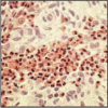 Figure 12.11. Eosinophils can be detected easily in tissue sections by their bright refractile orange coloration.