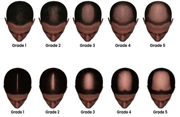 Androgenetic alopecia female  male causes diagnosis  treatment