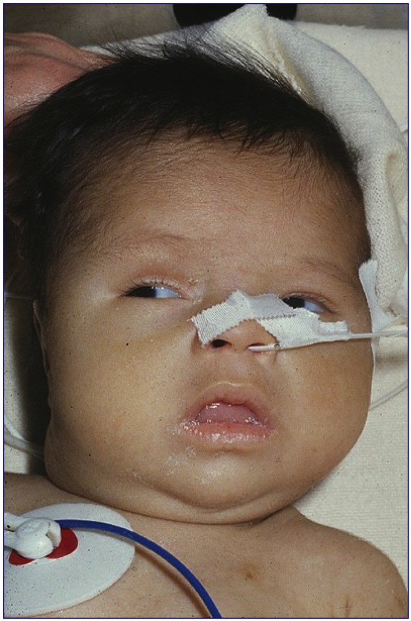 Figure 15-4. Three month old male infant who was diagnosed clinically when he presented with a history of poor feeding at 3 months of age.