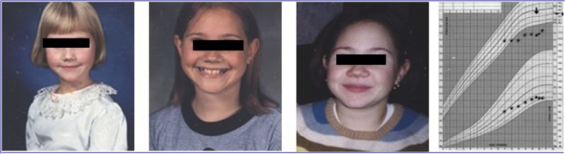 Figure 15-6. Sequential changes in physical appearance in a young girl who presented at 15 years of age with amenorrhea and hyperprolactinemia secondary to severe hypothyroidism.