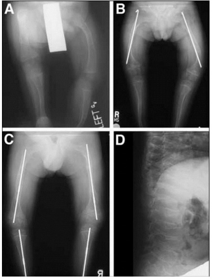 Understanding Osteogenesis Imperfecta: The Fragile Bone Disorder - Methods for diagnosis