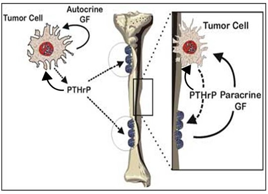 Figure 6. . Growth factor-regulated PTHrP production in tumor states.