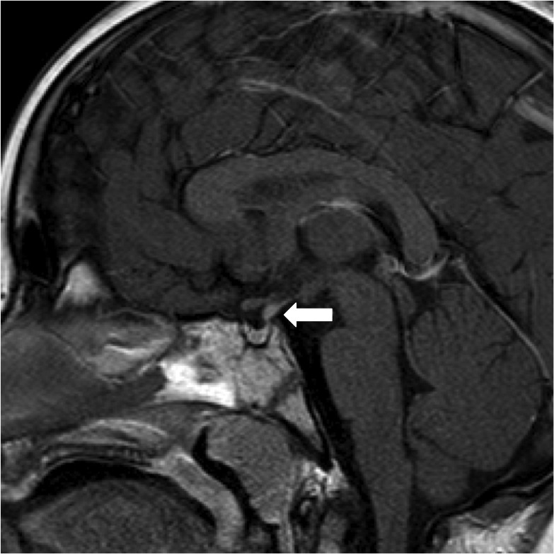 Pituitary and Hypothalamic Tumor Syndromes in Childhood - Endotext - NCBI  Bookshelf