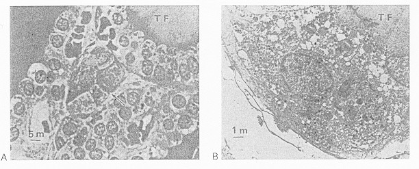 Fig. 1-4. (A) Light microscopy of a parafollicular cluster (arrow) in relationship to thyroid follicle (TF) (x900).