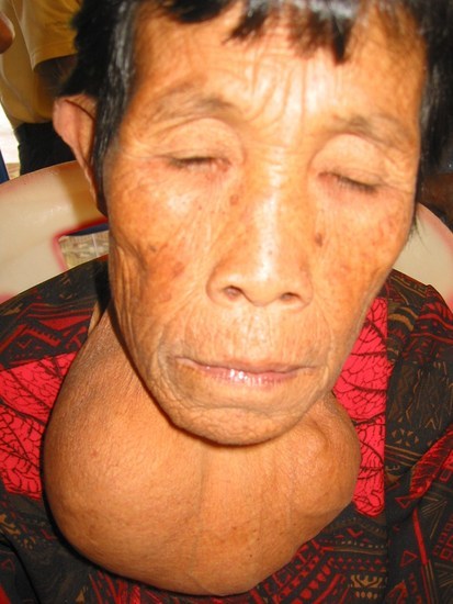 an elderly woman with a huge, longstanding multinodular goiter