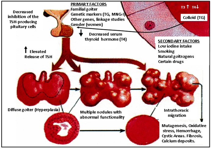 Multinodular Goiter Endotext Ncbi Bookshelf