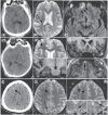 FIGURE 31.2. More extensive pathology demonstrated by MRI compared with CT in the study participants.