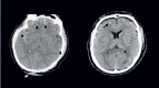 FIGURE 31.3. (Left) Hemorrhagic contusions as noted on DOI CT after a blow to the occiput, as indicated by soft-tissue swelling (white arrow) with characteristic contrecoup hemorrhagic contusions are seen in the inferior frontal and temporal lobes (black arrows).